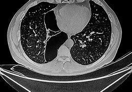 Image result for Bullous Emphysema X-ray