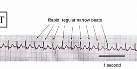 Image result for Run of SVT