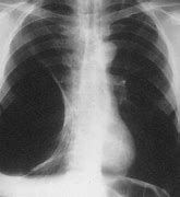 Image result for Bullous Emphysema X-ray