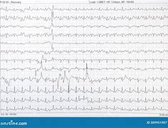 Image result for Heart Failure Electrocardiogram