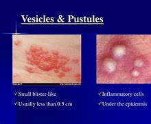 Image result for Viral Pustules