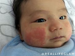 Image result for Eczema On Baby Arm