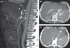 Image result for Angio CT Scan