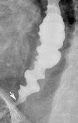 Image result for Esophageal Sphincter Spasm