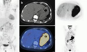 Image result for Hodgkin Lymphoma PET/CT