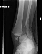 Image result for Ankle Fracture Circular Pop