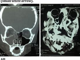 Image result for Subperiosteal Abscess Orbital Cellulitis