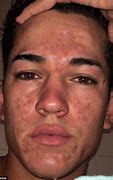 Image result for Acne Boy Face Map