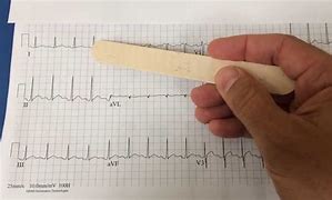 Image result for Pericarditis EKG Findings Example