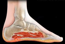 Image result for Plantar Fascia Rupture