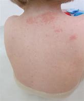 Image result for Circular Rash On Skin