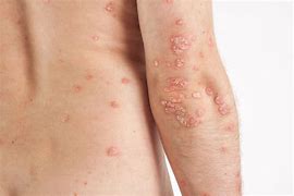 Image result for Psoriasis Bumps On Skin