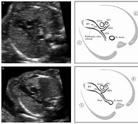 Image result for LVOT Rvot Ultrasound