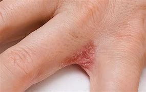 Image result for Eczema Rash On Hands