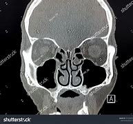 Image result for Coronal Lung CT