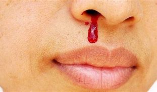 Image result for African Nose Bleed