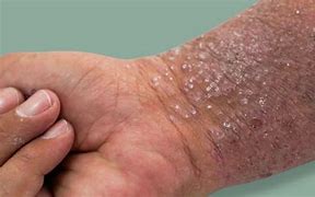 Image result for 10 Common Skin Rashes On Legs