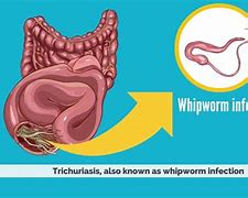 Image result for Trichiniasis