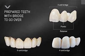 Image result for 3-Unit Bridge Front Teeth