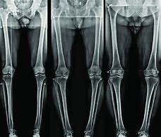 Image result for X-ray of Leg with Metal Plates