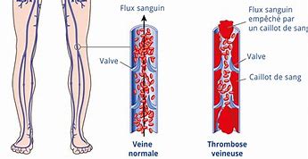 Image result for Thrombose Veineuse Musculaire IRM