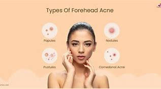 Image result for Pustules On Forehead