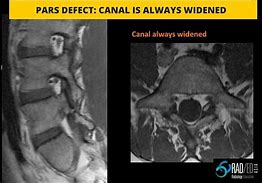 Image result for Pars Defect Lumbar Spine