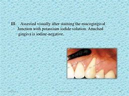 Image result for Attached Gingiva