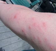 Image result for Poison Ivy Rash African American