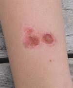 Image result for Circular Rash On Skin