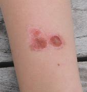 Image result for Small Red Circular Rash On Skin