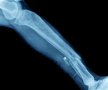 Image result for X-ray of Leg with Metal Plates