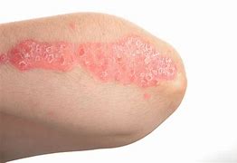 Image result for Psoriasis Bumps On Skin