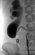 Image result for Retrocaval Ureter vs Normal