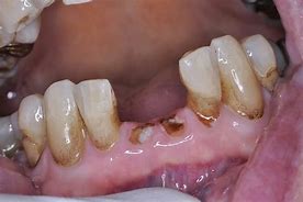 Image result for Molar Tooth Roots