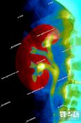 Image result for Kidney On X-ray