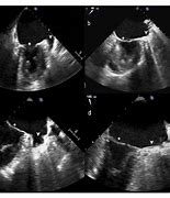 Image result for Thoracoscopic Left Atrial Appendage Clipping