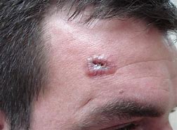 Image result for Basal Cell Carcinoma Cancer Symptoms