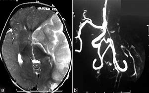 Image result for Brain MRI Angiogram