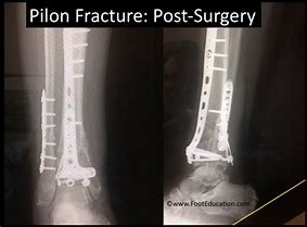 Image result for Open Pilon Fracture