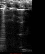 Image result for Lung Ultrasound B Lines Pulmonary Edema