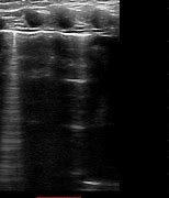 Image result for B Lines Chest Ultrasound