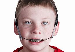 Image result for Orthodontic Headgear