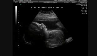 Image result for 3 Month Pregnancy Ultrasound