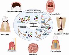 Image result for Candida Throat Infection