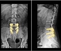 Image result for Lumbosacral Fusion