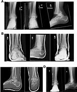 Image result for Trimalleolar Ankle Fracture 4 Plates