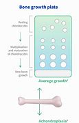 Image result for Achondroplasia Height Chart