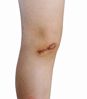 Image result for Knee Scab