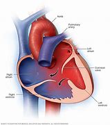 Image result for Complete Atrioventricular Canal Defect